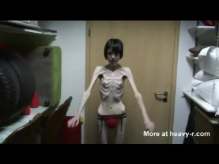 anorexia.